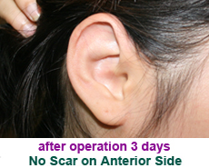 plastic-surgery-prominent-ear 